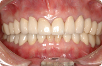 Case1_After_1