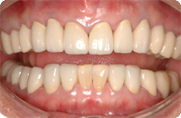 Case1_After_2