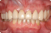 Case2_After_1