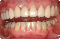 Case2_After_2