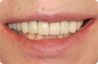 Case2_After_4