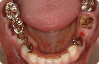 Case3_Before_2