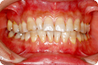 Case1_After