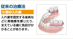 従来の治療法 入れ歯を固定する金具などに異物感を感じたり、支えている歯に負担がかかることがあります。